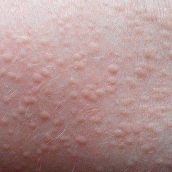Treatment of skin diseases